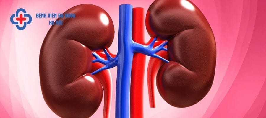 Sỏi tắc niệu quản gây ứ nước tại thận và niệu quản