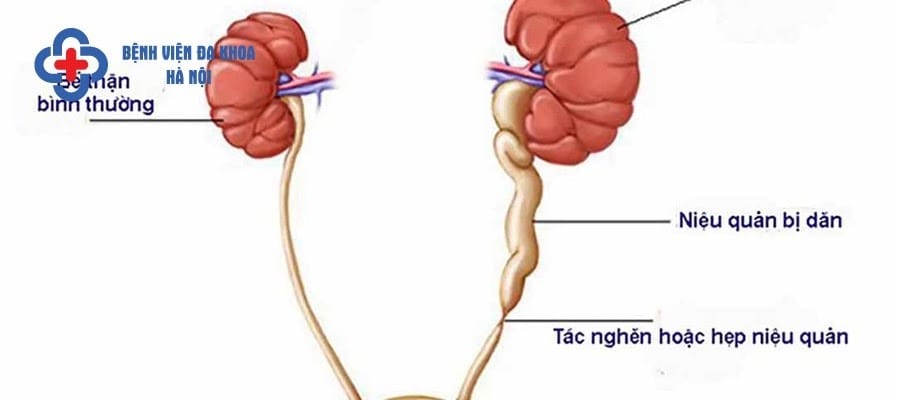 Sỏi tắc niệu quản khiến người bệnh phải đối mặt với nhiều nguy hiểm