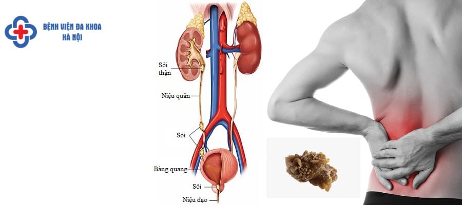 Sỏi thận nhỏ cũng cần điều trị sớm để tránh biến chứng soi than nho co nguy hiem