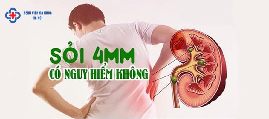 Bệnh nhân bị sỏi thận 4mm thường sẽ đau lưng hoặc đau bụng