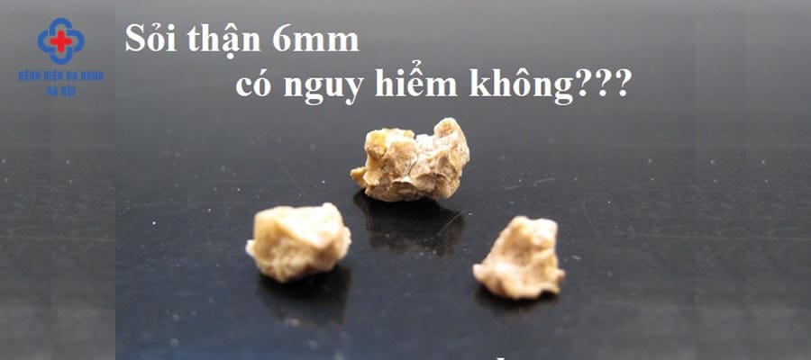 Dù chưa gây ảnh hưởng nhiều nhưng không nên chủ quan với sỏi thận 6mm soi than 6mm co nguy hiem khong