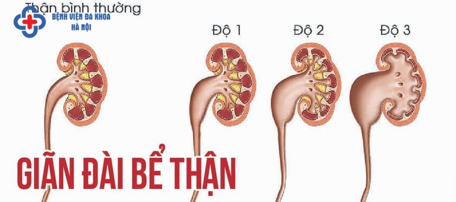 Sỏi thận 8mm nếu không kịp thời điều trị có thể gây nhiều biến chứng