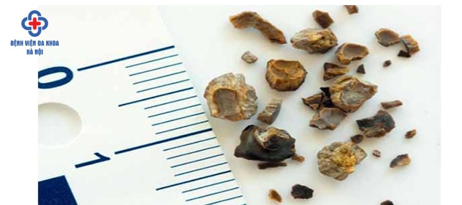 Sỏi thận kích thước nhỏ có thể điều trị nội khoa soi than bao nhieu mm