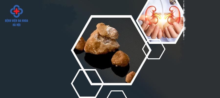 Nên điều trị sỏi ở các cơ sở y tế uy tín soi than bao nhieu mm phai mo