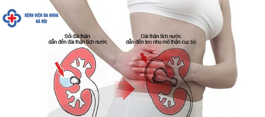 Sỏi thận có thể chữa bằng nhiều phương pháp