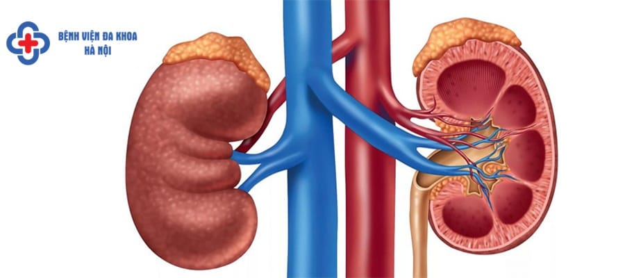 Chữa sỏi thận sớm để tránh biến chứng nặng nề soi than dieu tri som