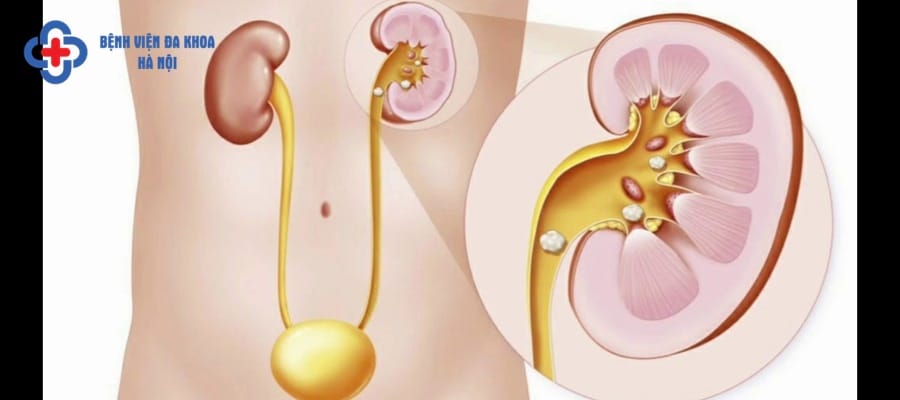 Sỏi thận có kích thước lớn cần được mổ sớm