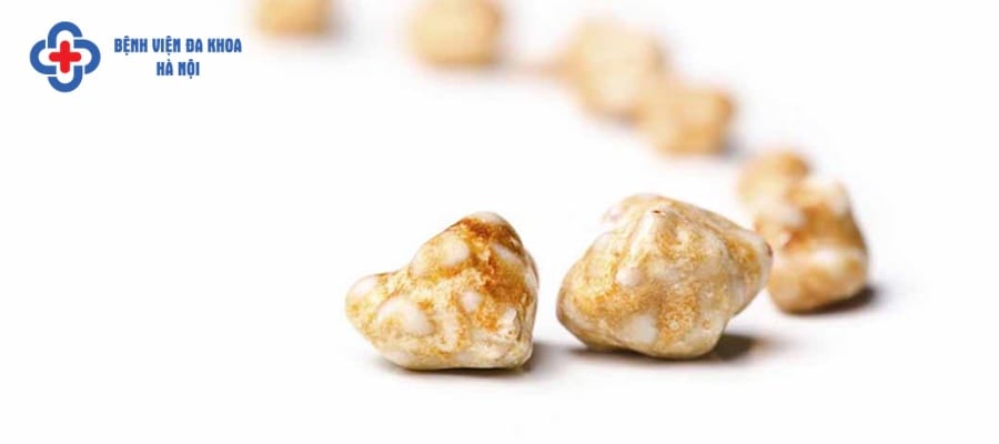 Sỏi thận có nhiều kích thước và hình dạng khác nhau