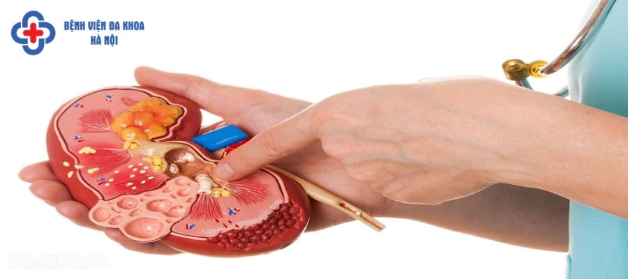 Sỏi thận được tạo nên từ các khoáng chất trong nước tiểu