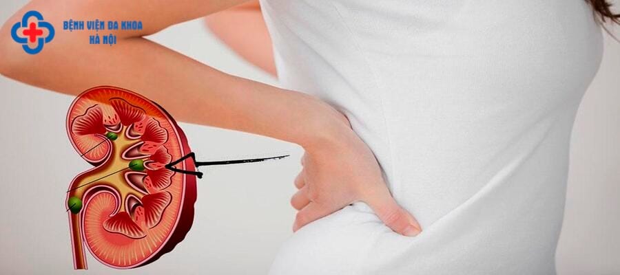 Sỏi thận gây đau tại vùng thắt lưng Sỏi thận gây đau tại vùng thắt lưng