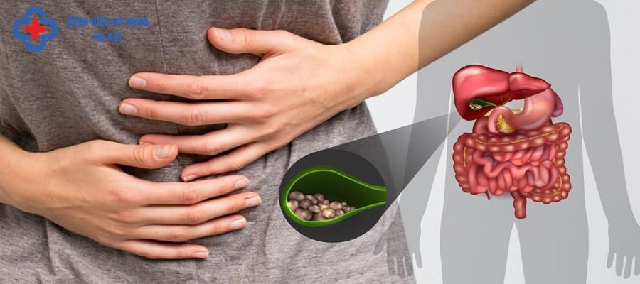 Sỏi thận gây nhiều bất tiện trong sinh hoạt của người bệnh