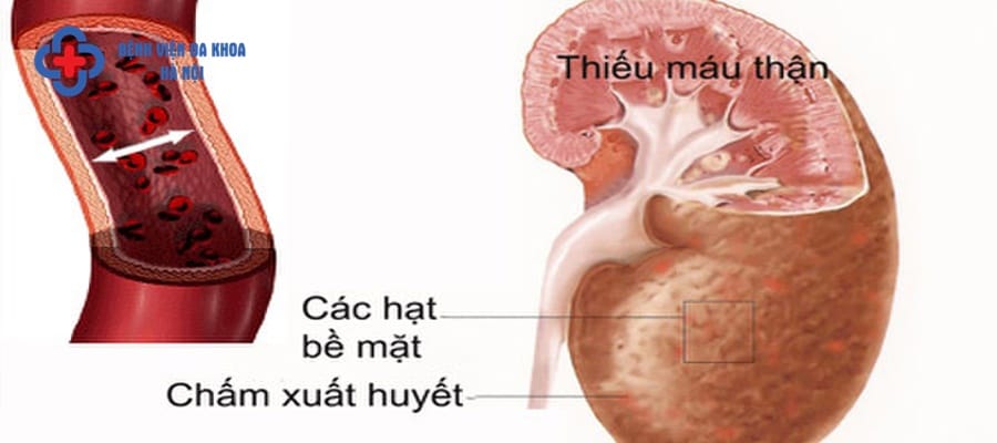 Sỏi thận gây nhiều biến chứng nguy hiểm