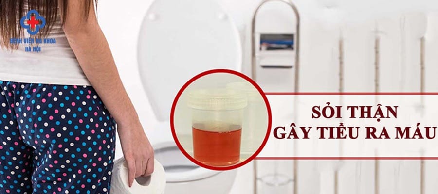 Sỏi thận có thể gây ra hiện tượng tiểu ra máu