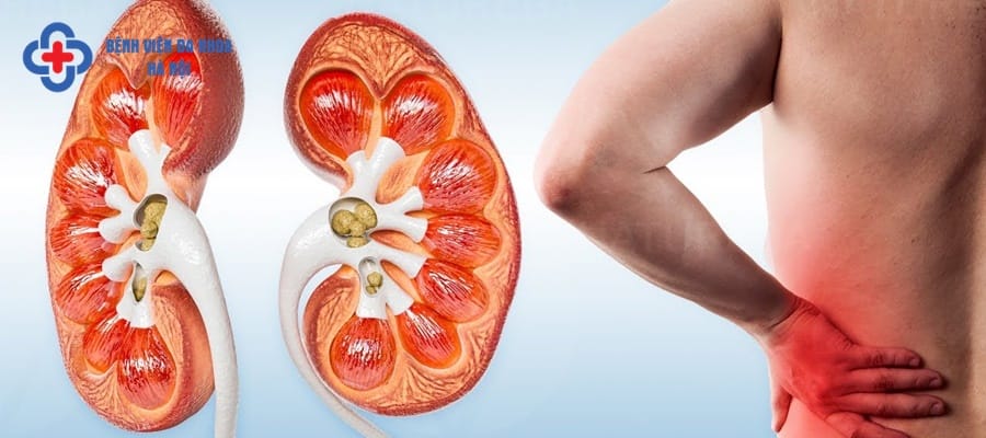 Sỏi thận hình thành do kết tinh khoáng chất trong nước tiểu thời gian dài