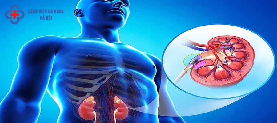 Sỏi thận hình thành do quá trình lắng đọng các khoáng chất