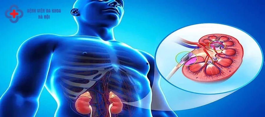 Sỏi thận hình thành do quá trình lắng đọng các khoáng chất