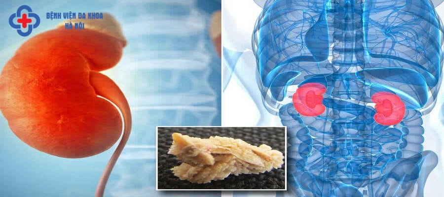 Sỏi thận hình thành qua quá trình lắng đọng trong nước tiểu