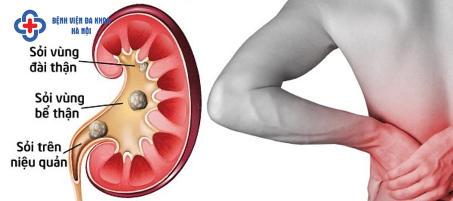 Sỏi thận hình thành trong quá trình lâu dài