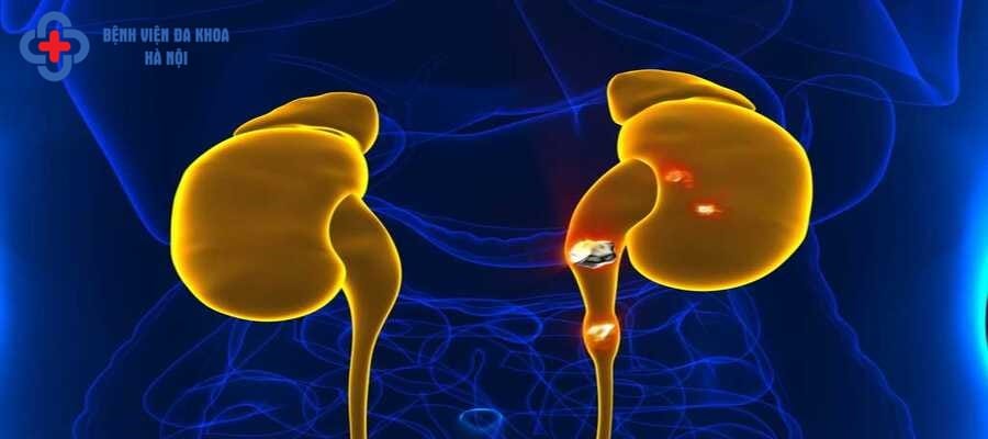 Sỏi thận kích thước to cần được tiến hành mổ lấy sỏi