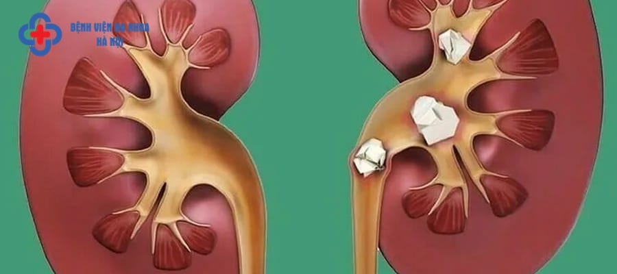 Sỏi thận là bệnh lý phổ biến ở nước ta
