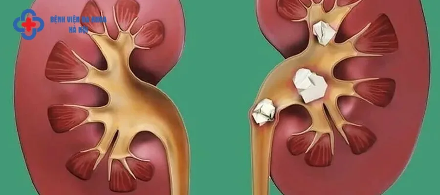 Sỏi thận là bệnh lý phổ biến ở nước ta
