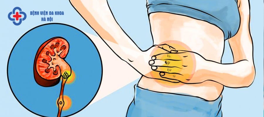 Sỏi thận là căn bệnh khiến người bệnh chịu nhiều đau đớn