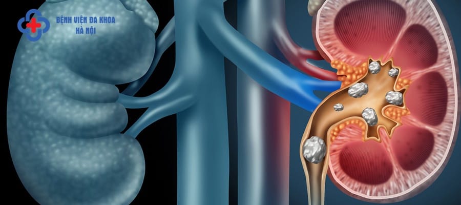 Sỏi thận là căn bệnh nguy hiểm thường gặp