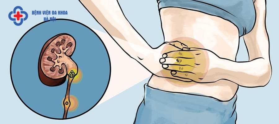 Sỏi thận là căn bệnh nhiều người mắc phải