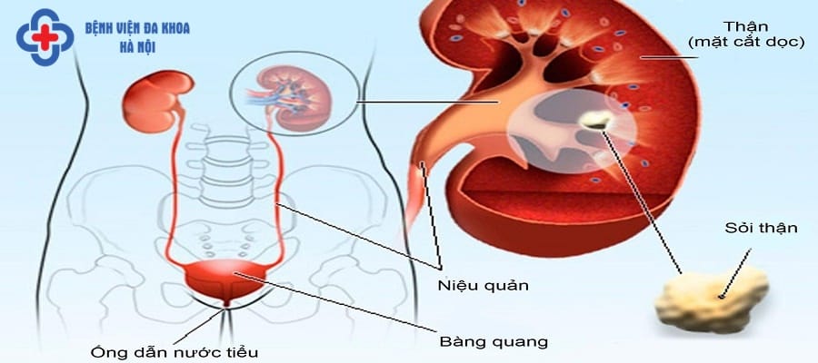 Sỏi thận là căn bệnh phổ biến hiện nay