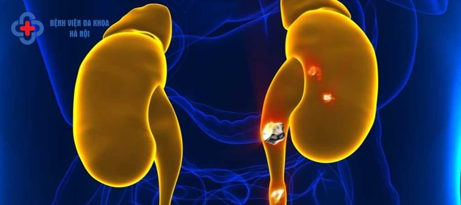 Sỏi thận là căn bệnh rất phổ biến hiện nay