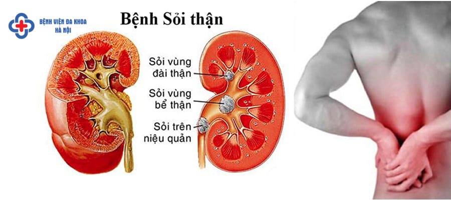 Bệnh sỏi thận gây đau đớn và phiền toái