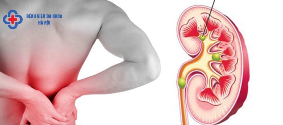 Bệnh sỏi thận có nguyên nhân do sinh hoạt và ăn uống soi than nho la gi