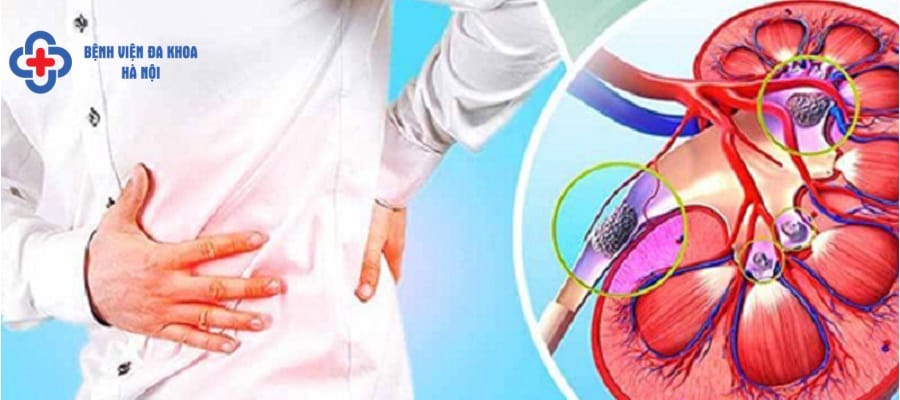 Nên mổ hay tán sỏi là băn khoăn của nhiều bệnh nhân chua tri soi than