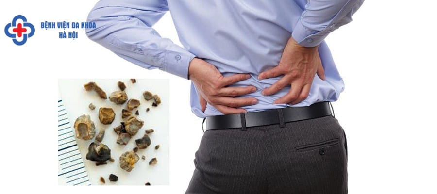 Sỏi thận nhỏ có thể điều trị nội khoa để đẩy sỏi ra ngoài soi than 3mm uong thuoc gi
