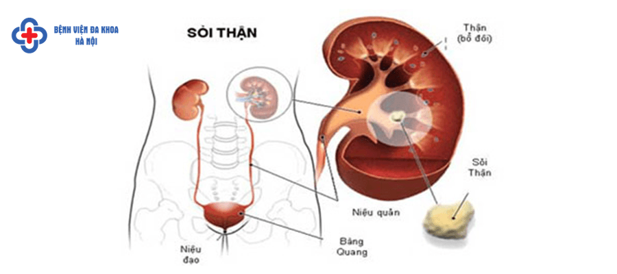 Sỏi bàng quang nên được chữa trị sớm tránh biến chứng soi than roi xuong bang quang