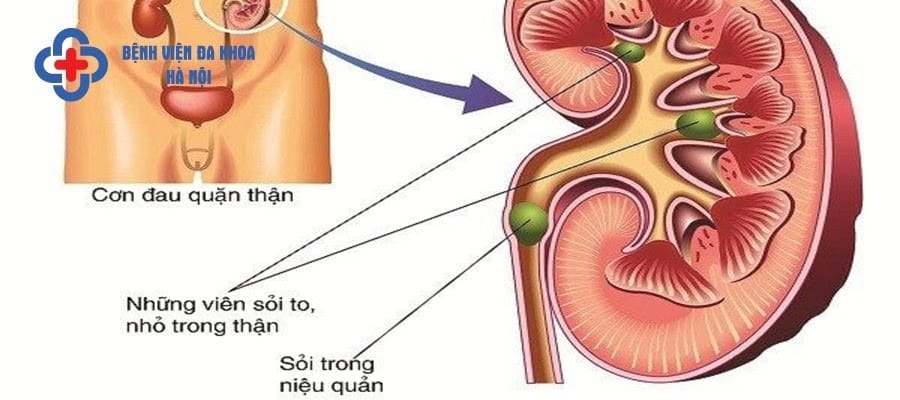 Sỏi thận rơi xuống niệu quản gây tắc niệu quản
