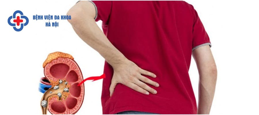 Khi bị đau do sỏi thận nên đi khám sớm để điều trị kịp thời
