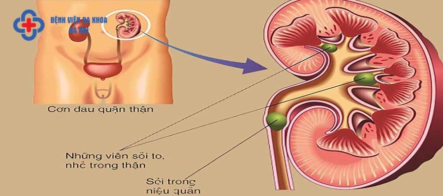 Sỏi tiết niệu gây nên nhiều biến chứng nguy hiểm