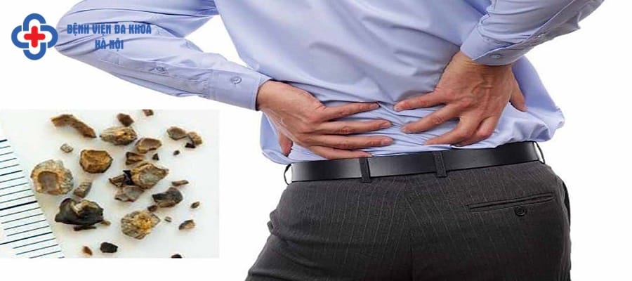 Sỏi tiết niệu khiến người bệnh đau đớn tại vùng thắt lưng