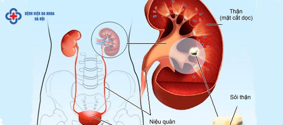 Sỏi tiết niệu ảnh hưởng tới quá trình bài tiết của thận gây đau buốt. soi tiet nieu la gi
