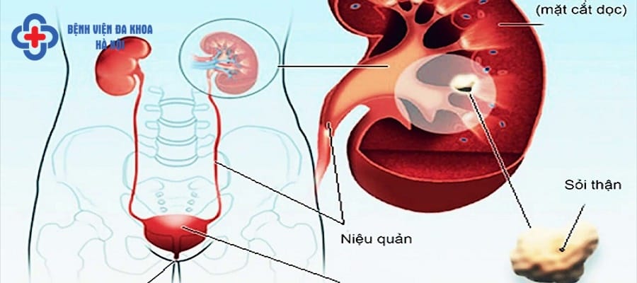 Sỏi tiết niệu khiến người bệnh đau đớn tại vùng thắt lưng Sỏi tiết niệu là tên gọi chung khi sỏi xuất hiện tại các bộ phận trong hệ tiết niệu