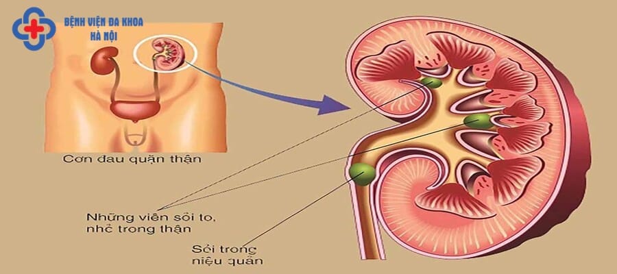 Sỏi trên niệu quản