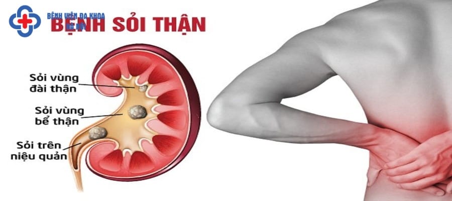 Sỏi vùng bể thận