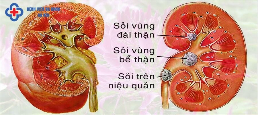 Sỏi xuất hiện ở đài thận