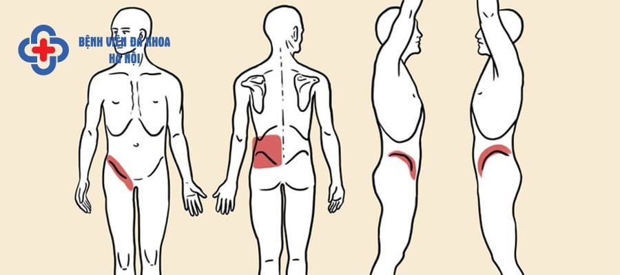 Các vị trí bị đau khi mắc sỏi thận