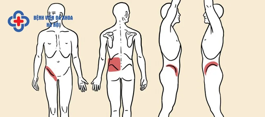Các vị trí bị đau khi mắc sỏi thận