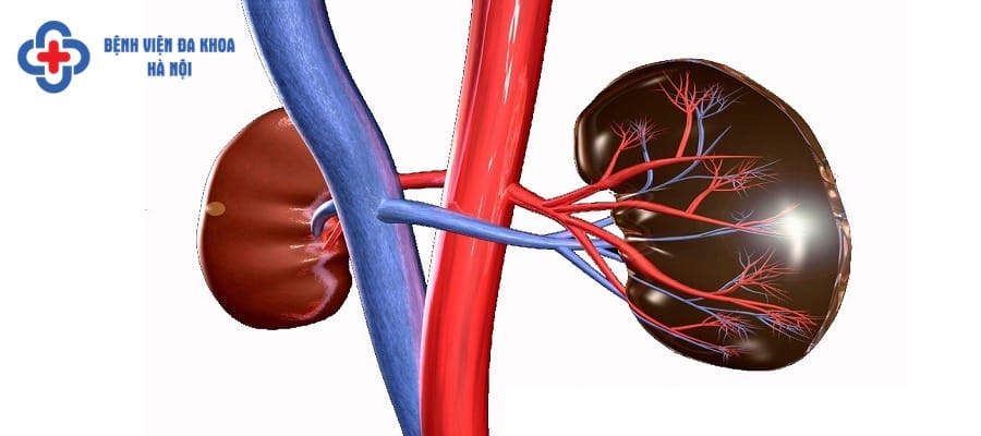 Suy thận là biến chứng nguy hiểm của người bị sỏi thận