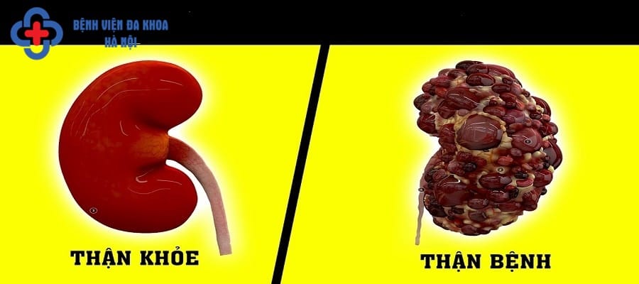 Suy thận là biến chứng thường gặp khi bị sỏi thận