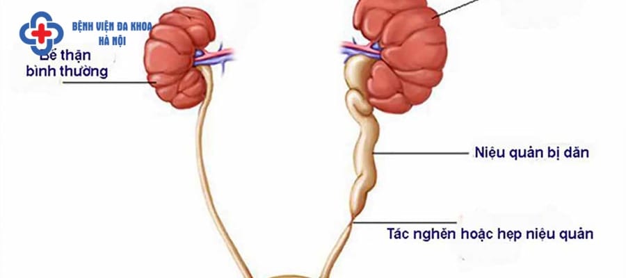 Tắc nghẽn đường tiểu là biến chứng thường gặp khi bị sỏi thận