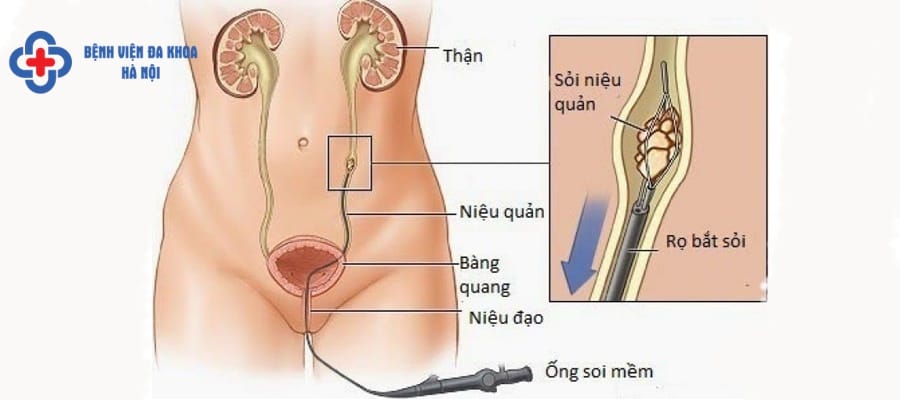 Tán sỏi bàng quang bằng laser có nhiều ưu điểm tan soi bang quang